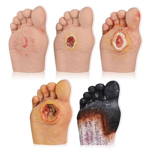 Ultrassist Diabetic Foot Care Model Set, Grade 1-5, 5 pcs